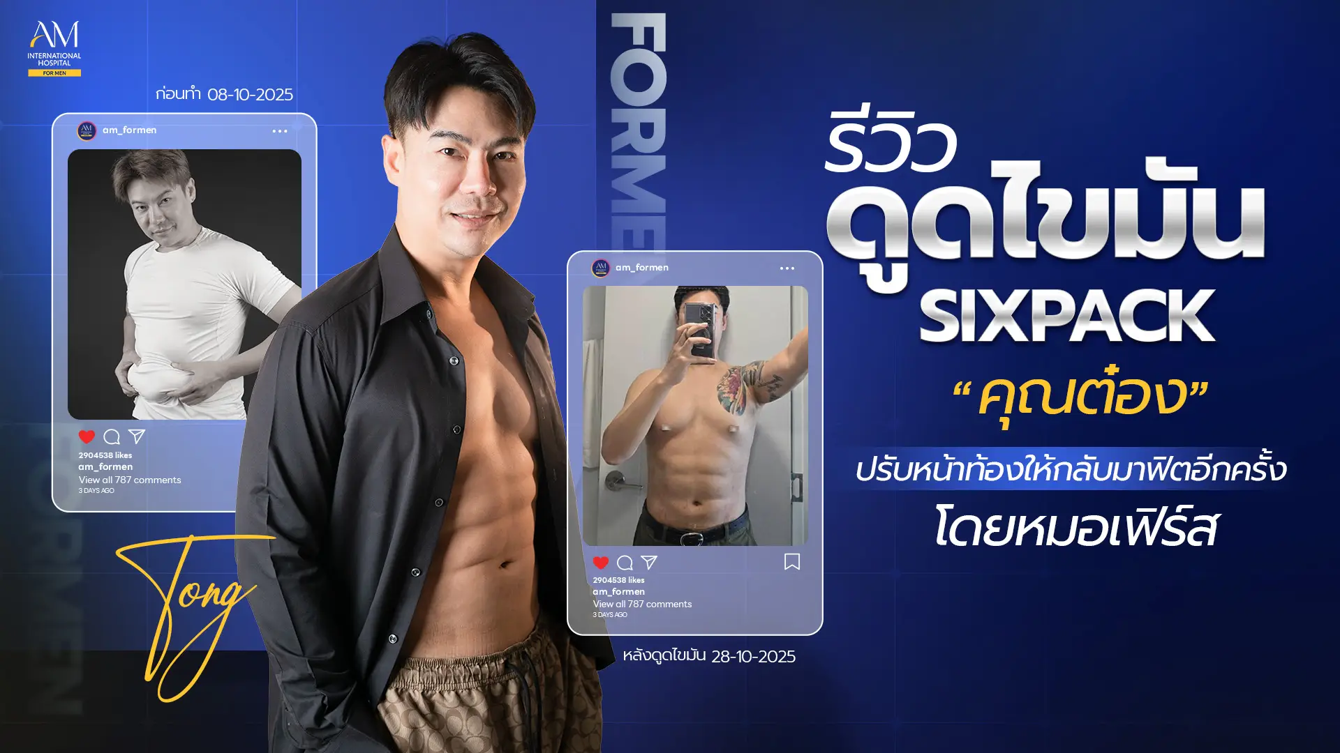 รีวิวดูดไขมัน Six Pack