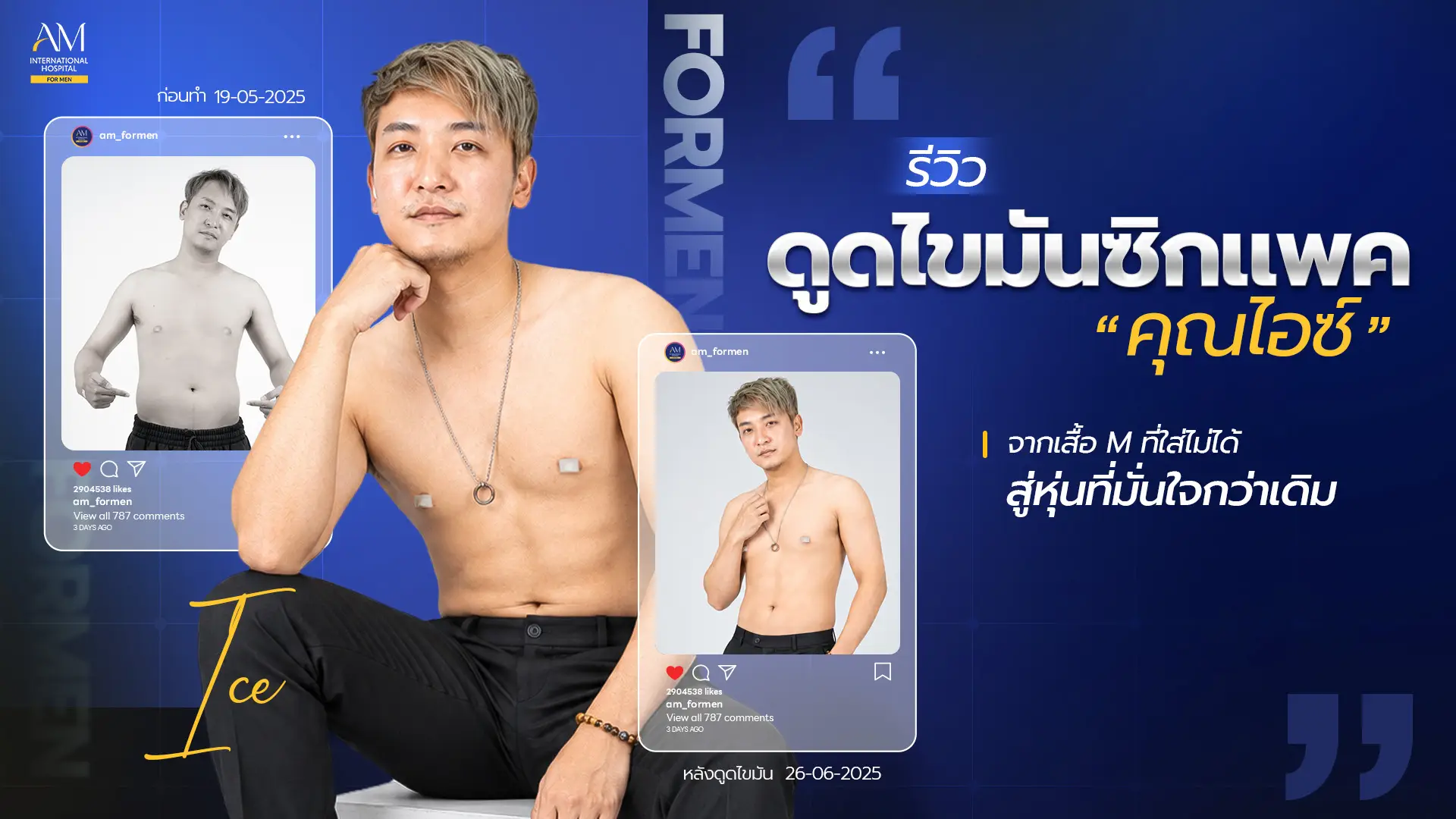 รีวิวดูดไขมันซิกแพค
