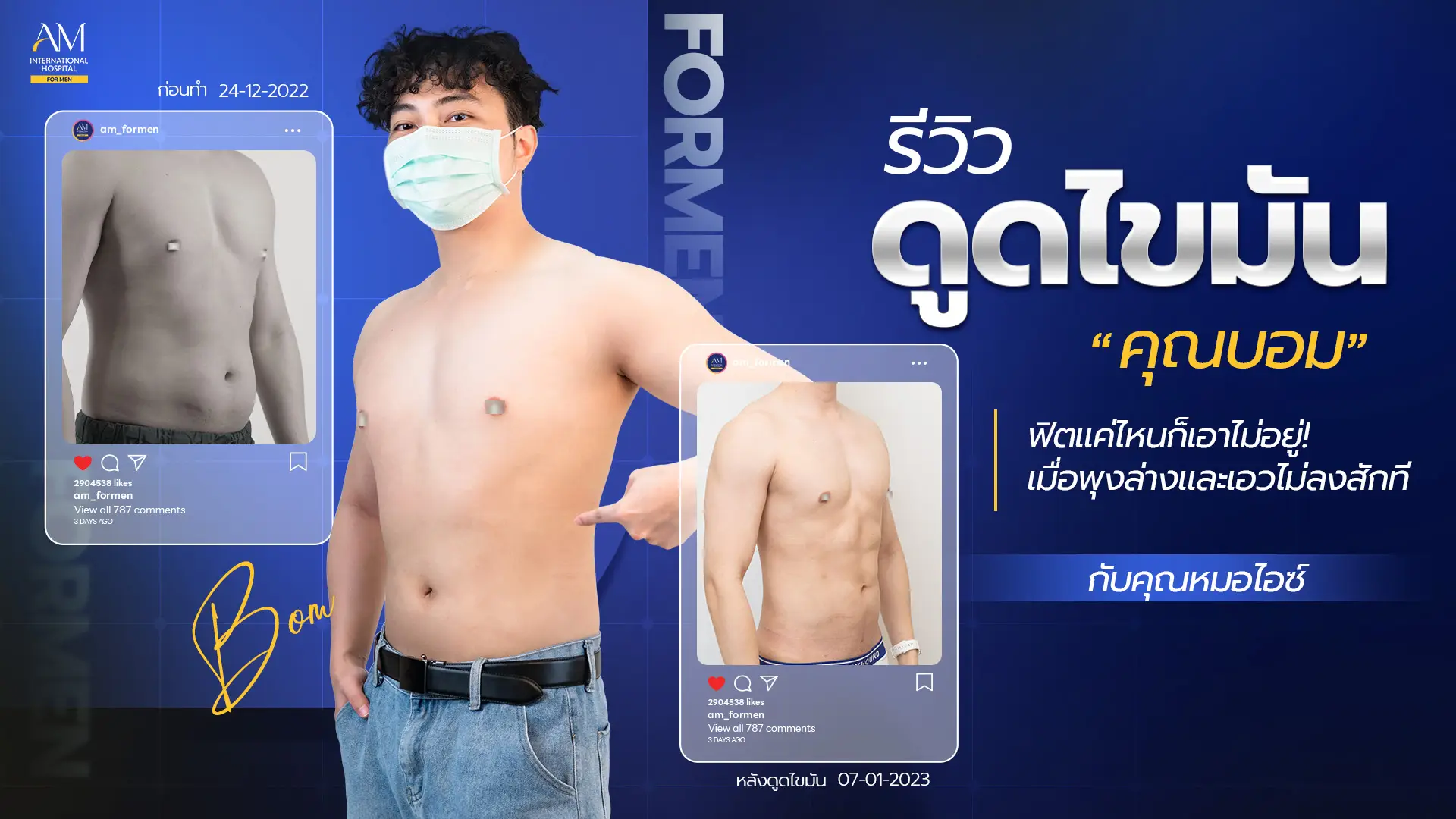 รีวิวดูดไขมัน