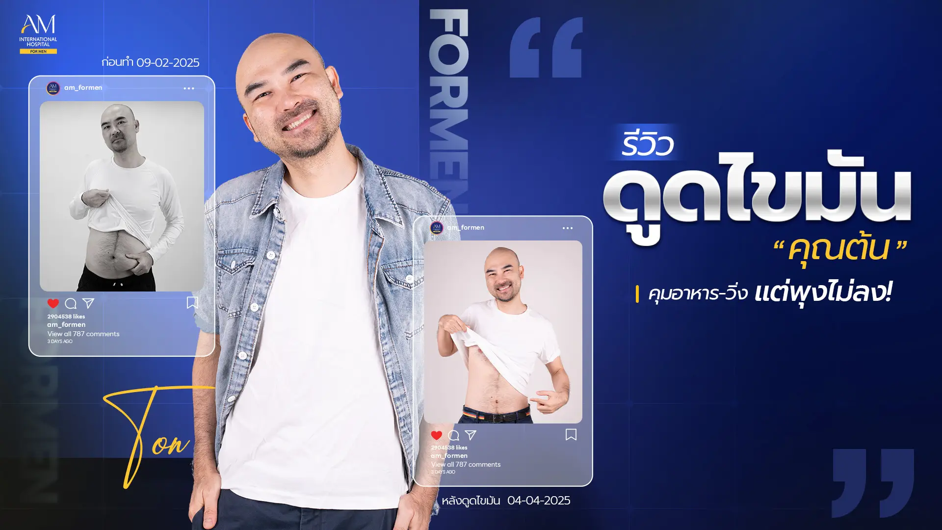 รีวิวดูดไขมัน