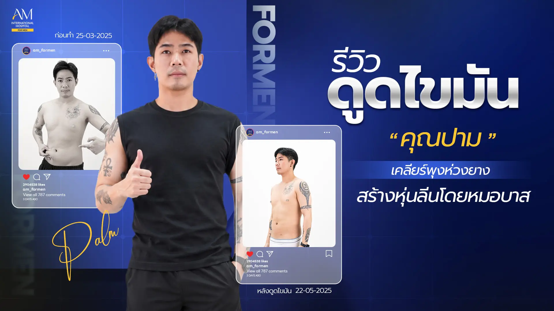 รีวิวดูดไขมัน