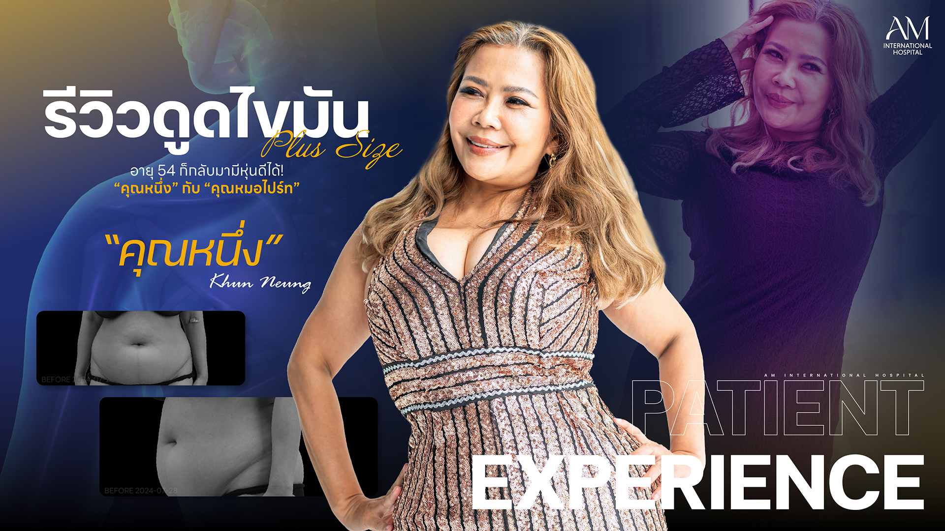รีวิวดูดไขมัน
