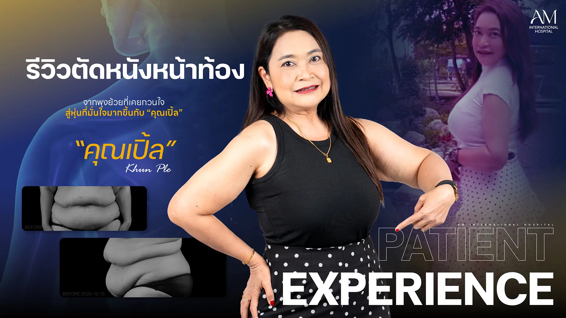 รีวิวตัดหนังหน้าท้อง