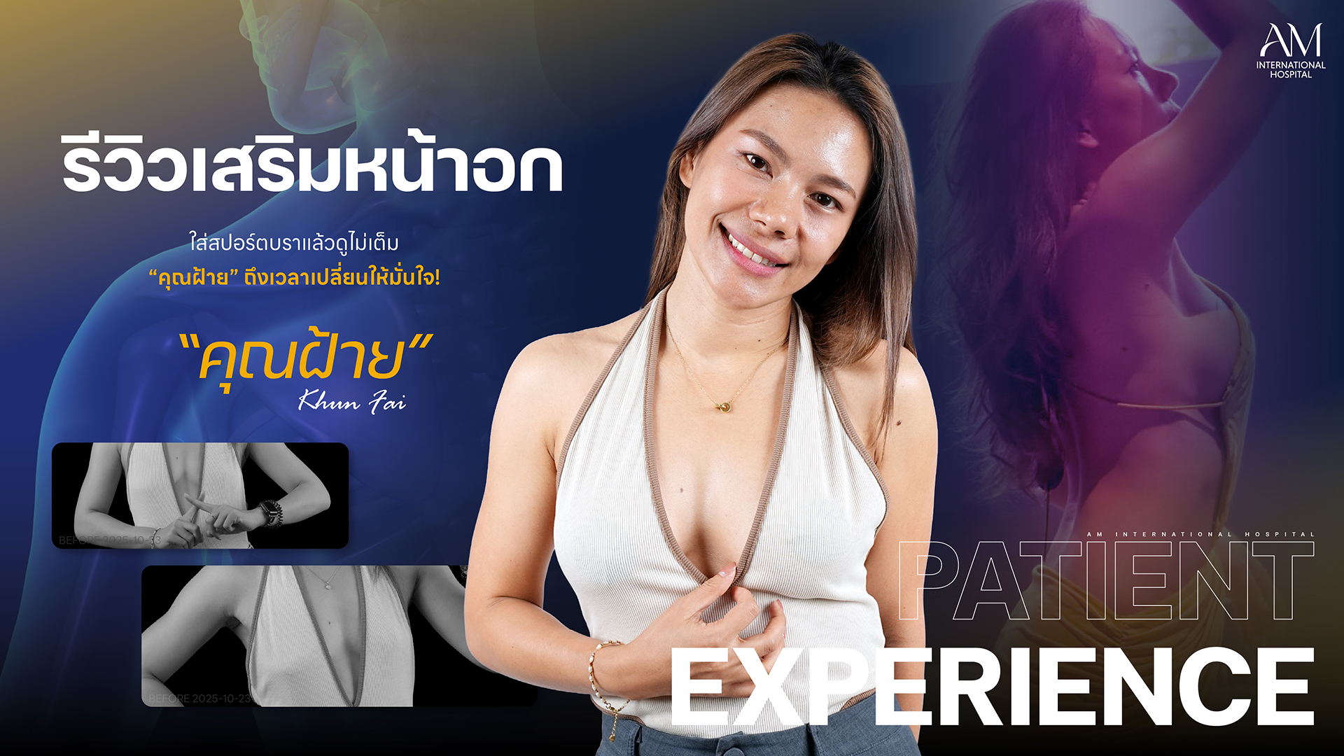 รีวิวเสริมหน้าอก