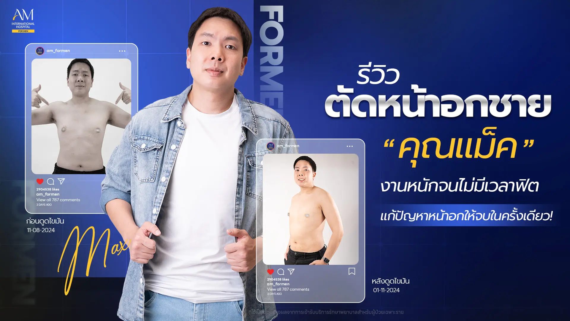รีวิวตัดหน้าอกชาย