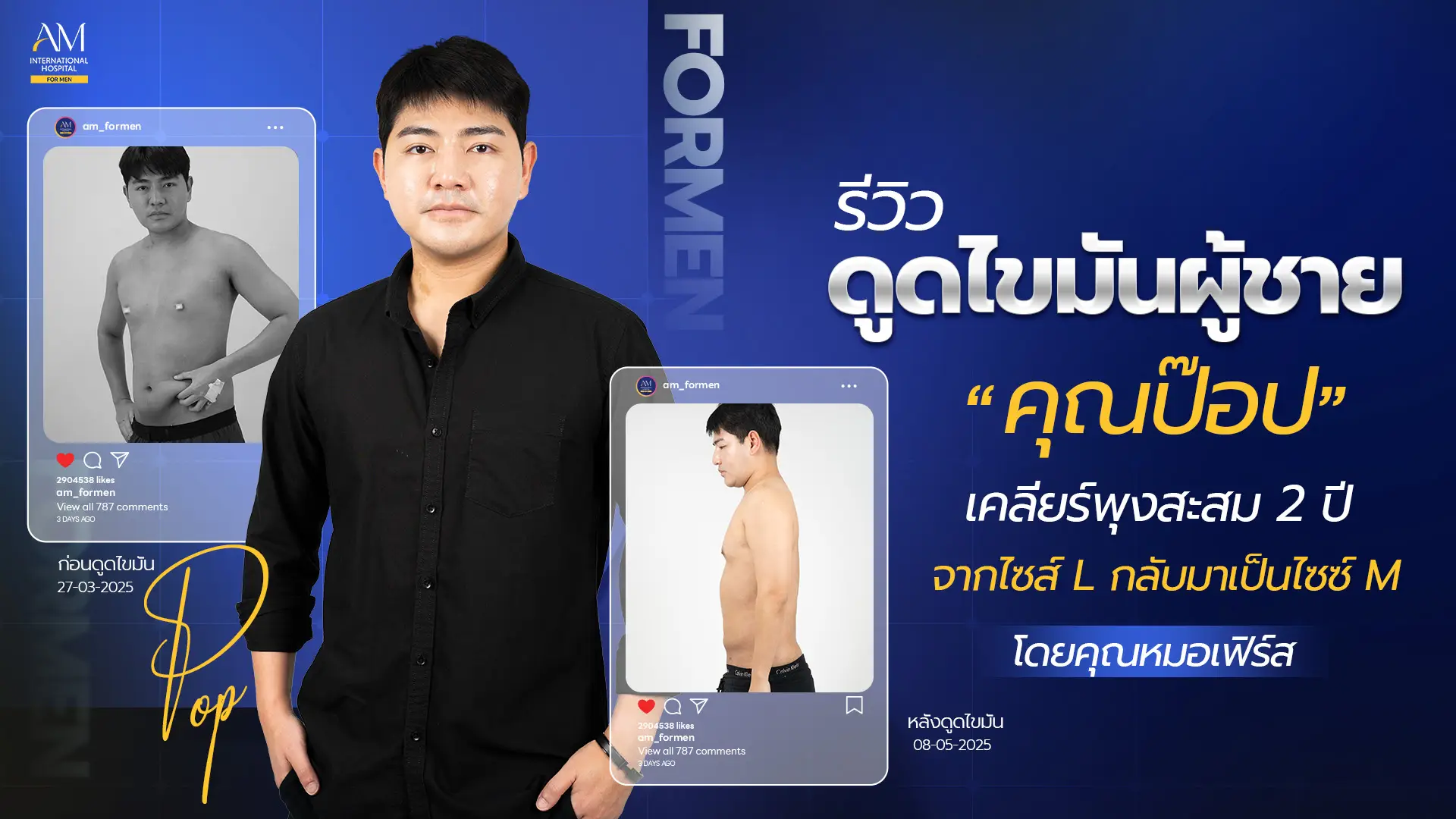 รีวิวดูดไขมันชาย