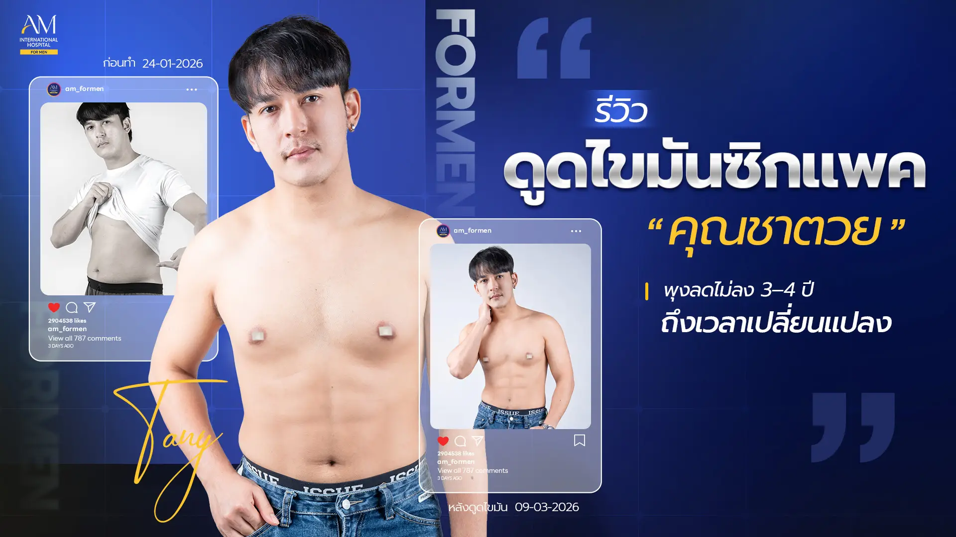 รีวิวดูดไขมันซิกแพค