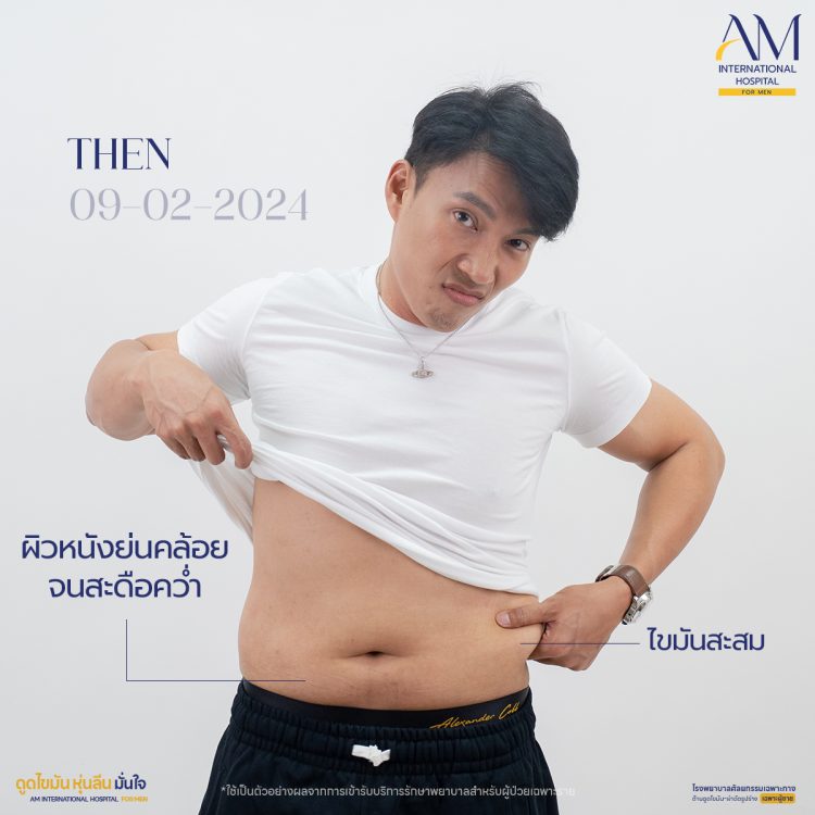 รีวิวดูดไขมันผู้ชาย ปัญหาของคุณกฤต