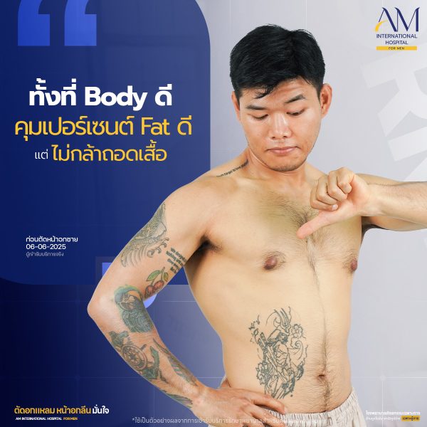 สัมภาษณ์ก่อนตัดหน้าอกชาย คุณเบิร์ด