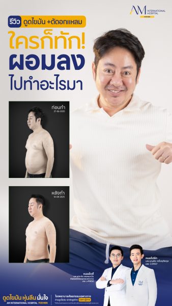 รีวิวตัดหน้าอกชาย คุณณัฐ ผลลัพธ์หลังทำ
